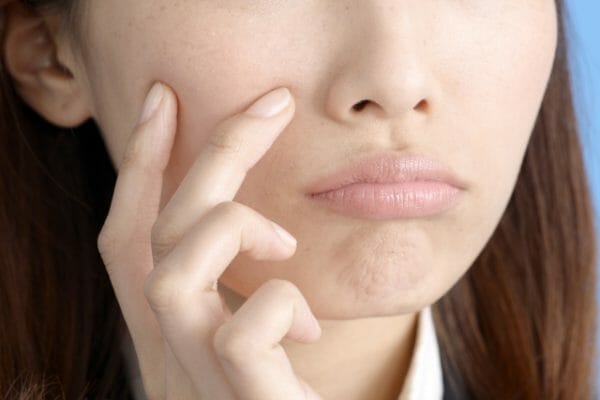 免疫力が低下して吹き出物が出てしまった女性のイメージ